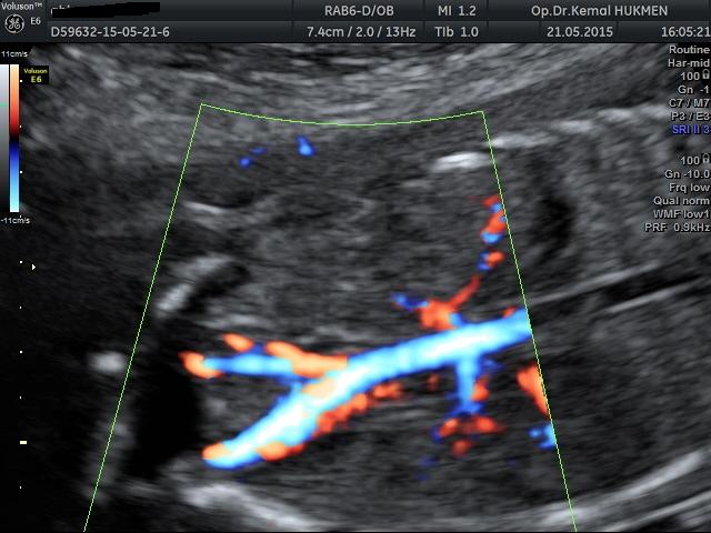Abdominal_Aortan#U0131n_(Kar#U0131n_Atar_Damar#U0131n#U0131n)_Dallanmas#U0131_Color_Doppler_G#U00f6r#U00fcnt#U00fcs#U00fc