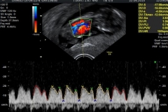 13_Hafta_3_G#U00fcnl#U00fck_Fet#U00fcs#U00fcn_Ductus_Venozis_Doppler_Ultrason_G#U00f6r#U00fcnt#U00fcs#U00fc