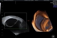 Yumurtal#U0131kta_Endometrioma(#U00c7ikolata)_Kisti_2D-4D_Ultrason_G#U00f6r#U00fcnt#U00fcs#U00fc