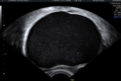 Yumurtal#U0131kta_Endometrioma(#U00c7ikolata)_Kisti_2D_Ultrason_G#U00f6r#U00fcnt#U00fcs#U00fc